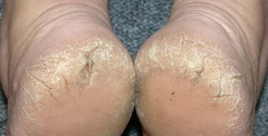What are Cracked Heels or Heel Fissures?